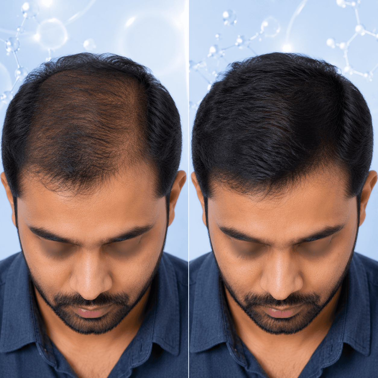 PRP hair density improvement