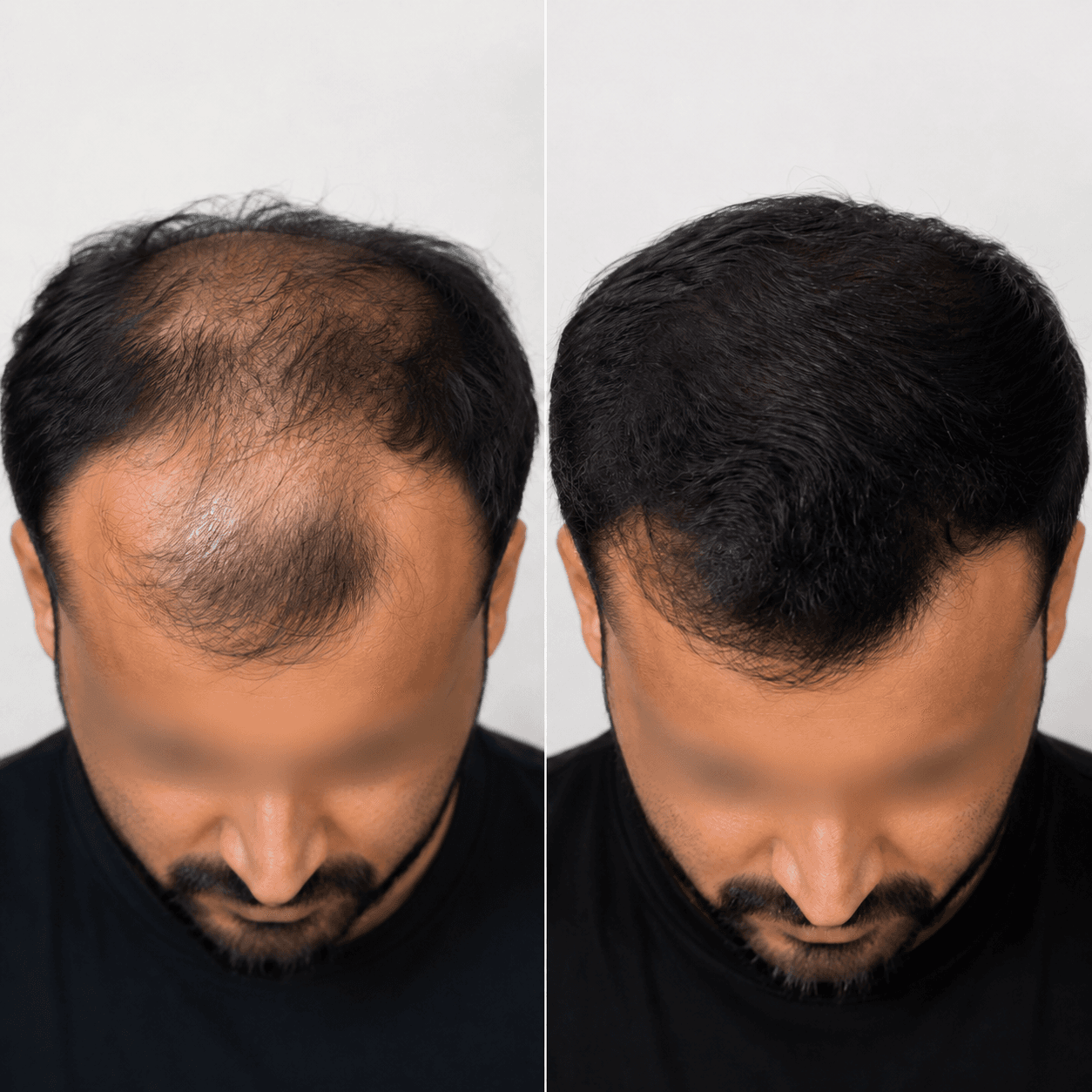 PRP hair restoration visual