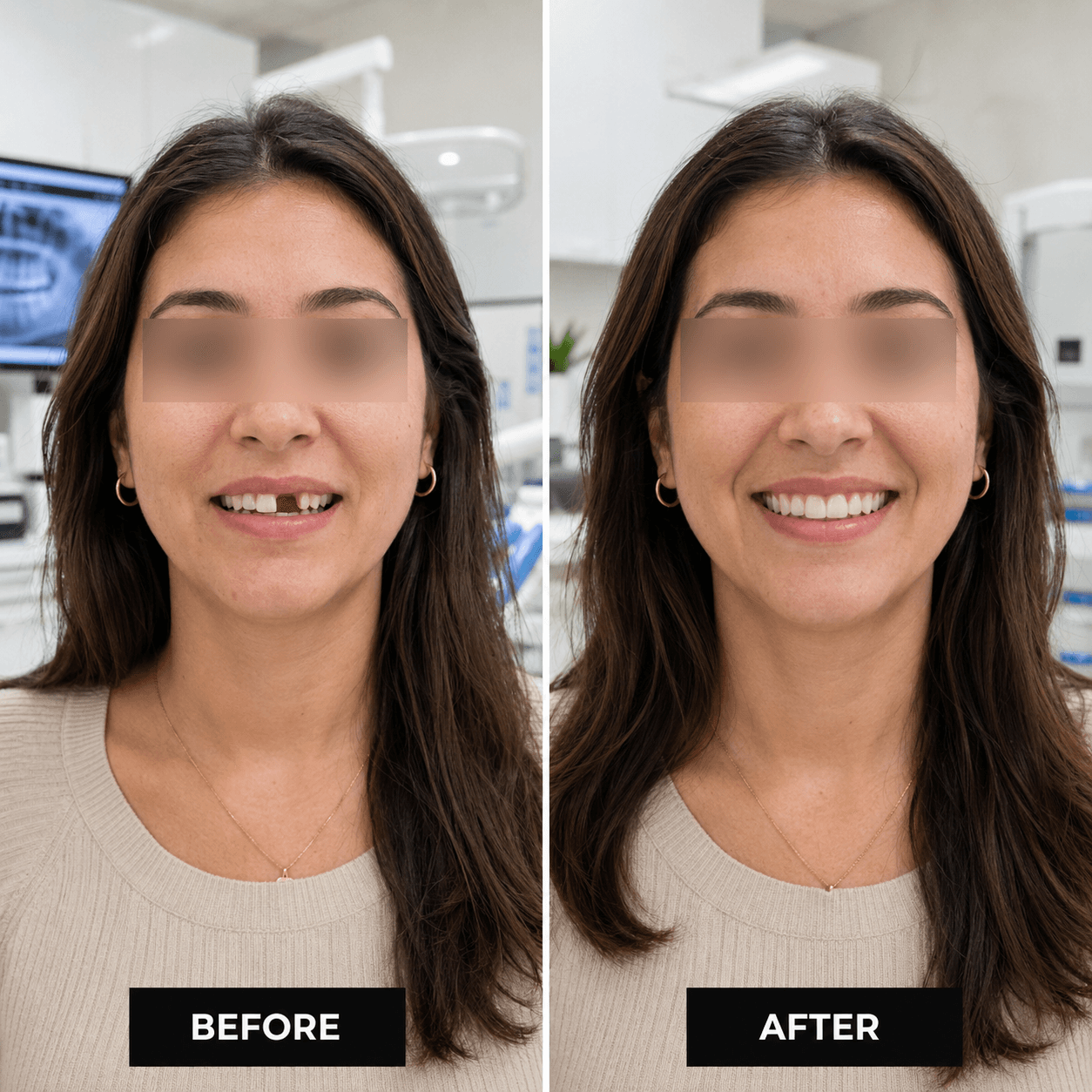 Dental implants restored bite result