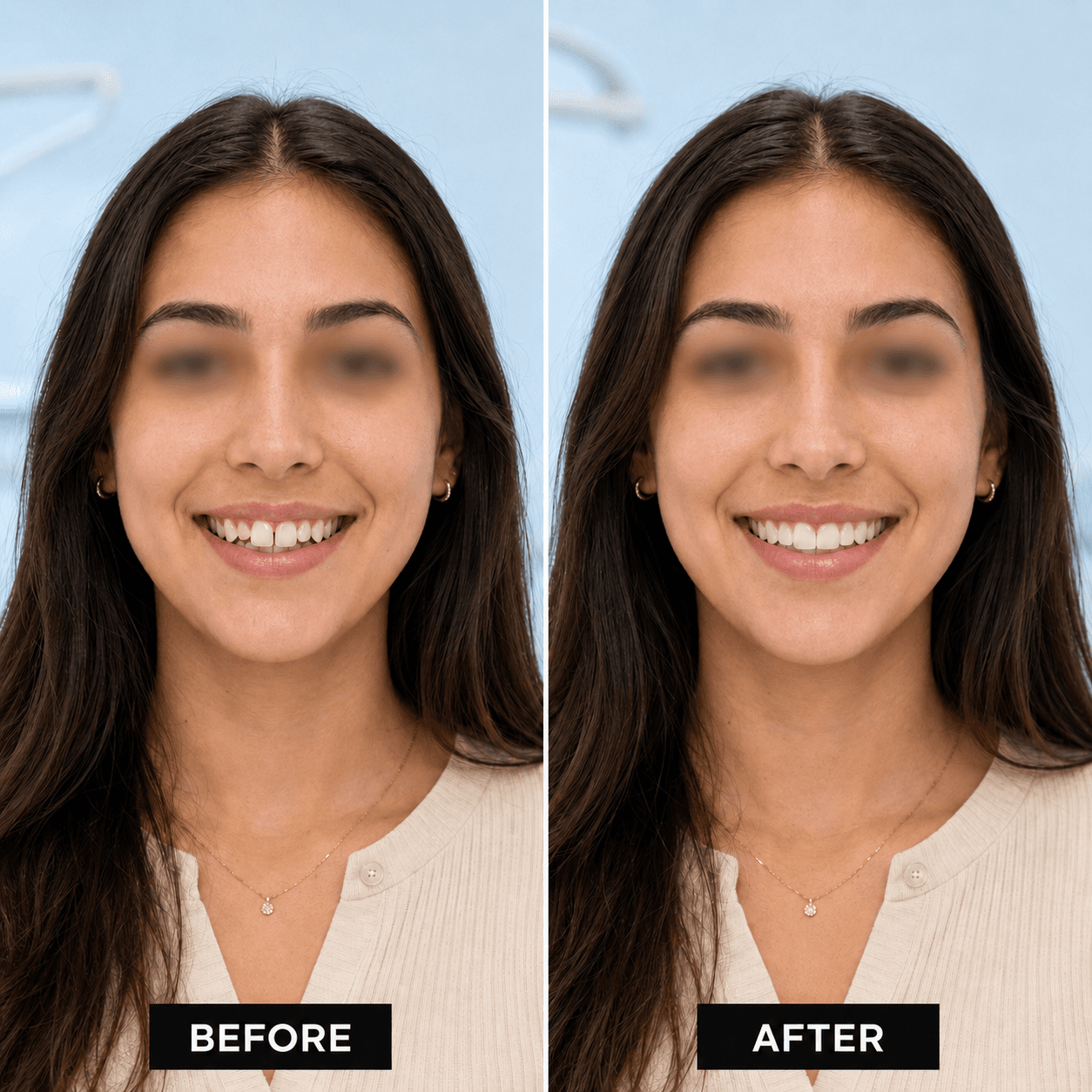 Clear aligners smile transformation showcase