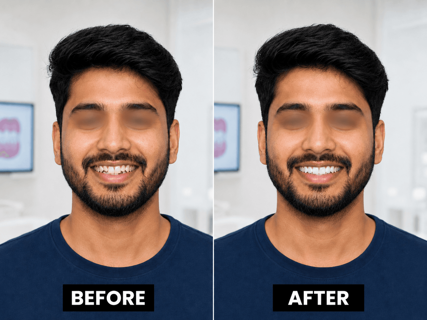 Clear aligners smile improvement visual
