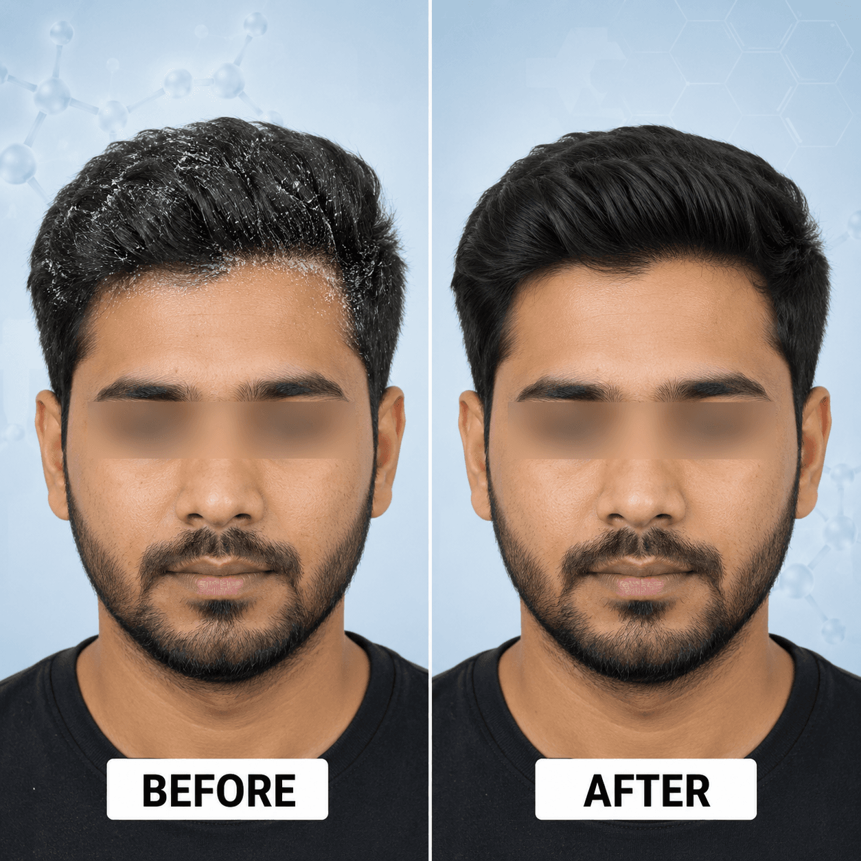 Scalp health improvement after dandruff treatment