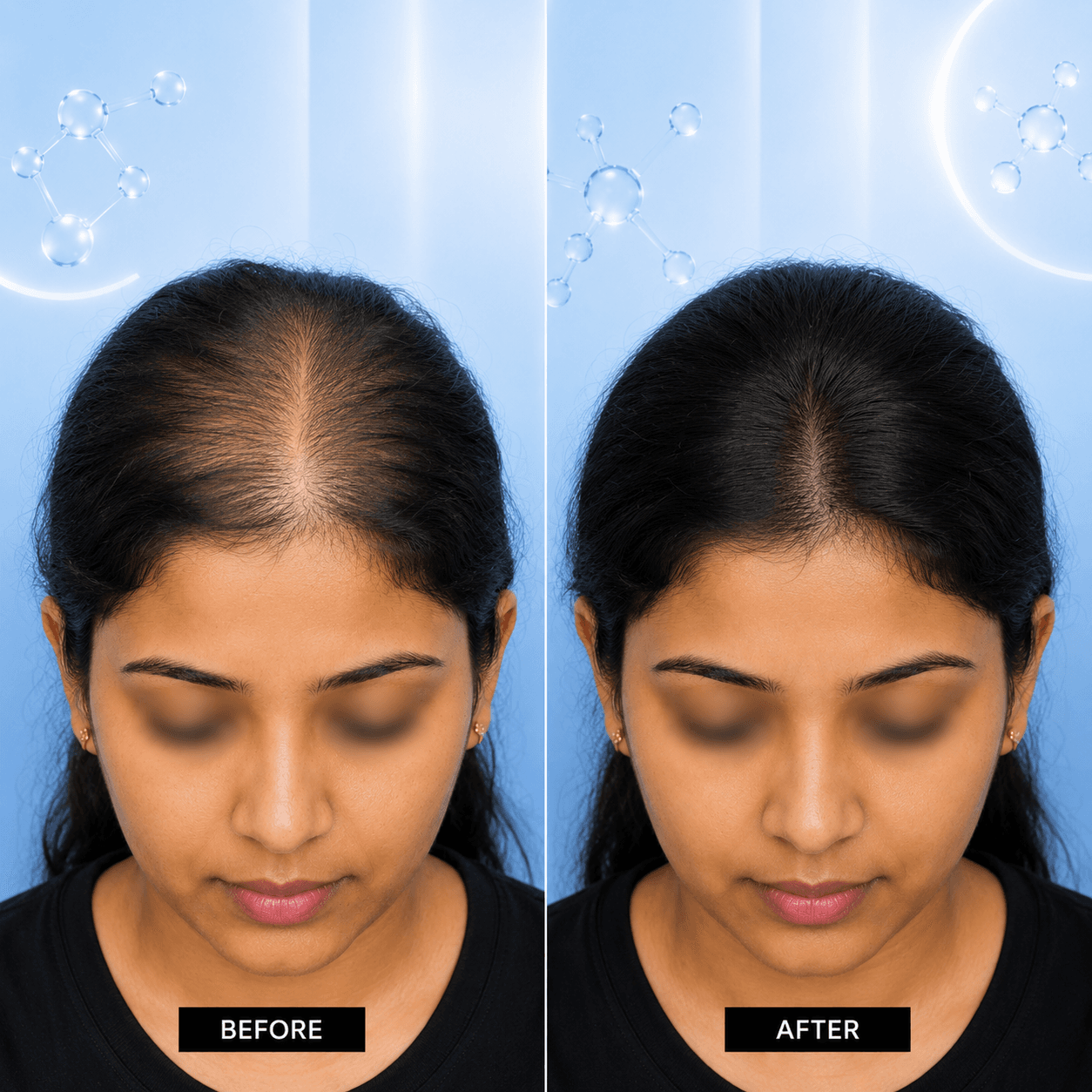 Microneedling hair density improvement