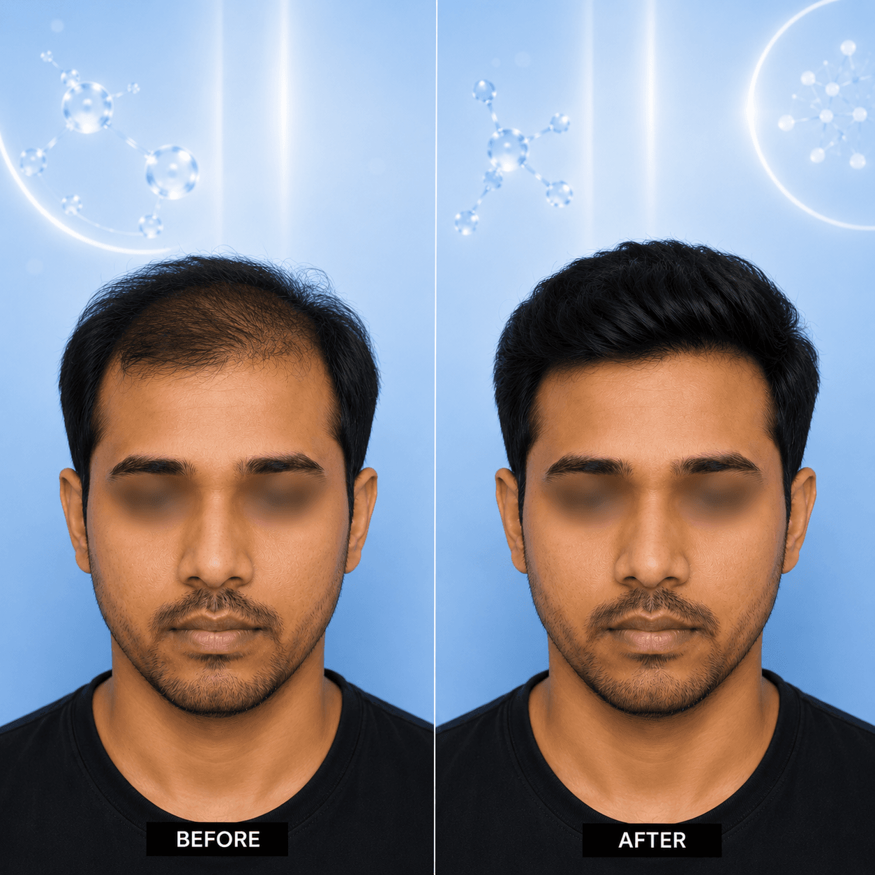 Microneedling hair restoration visual