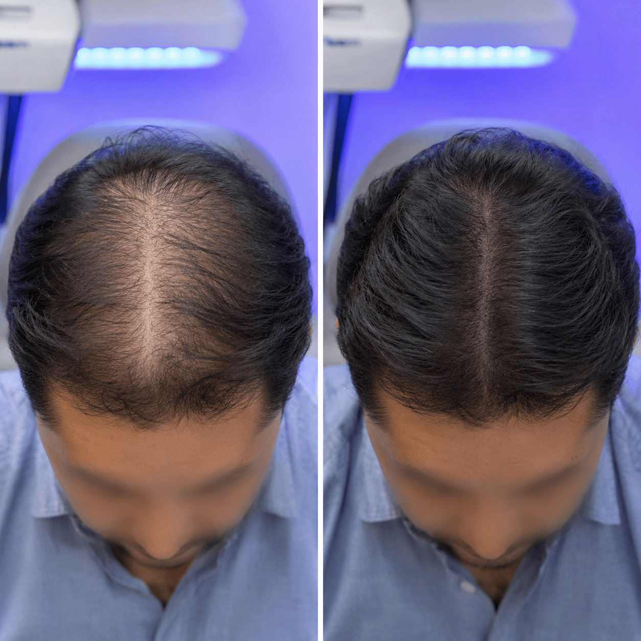 UV light therapy result showcase
