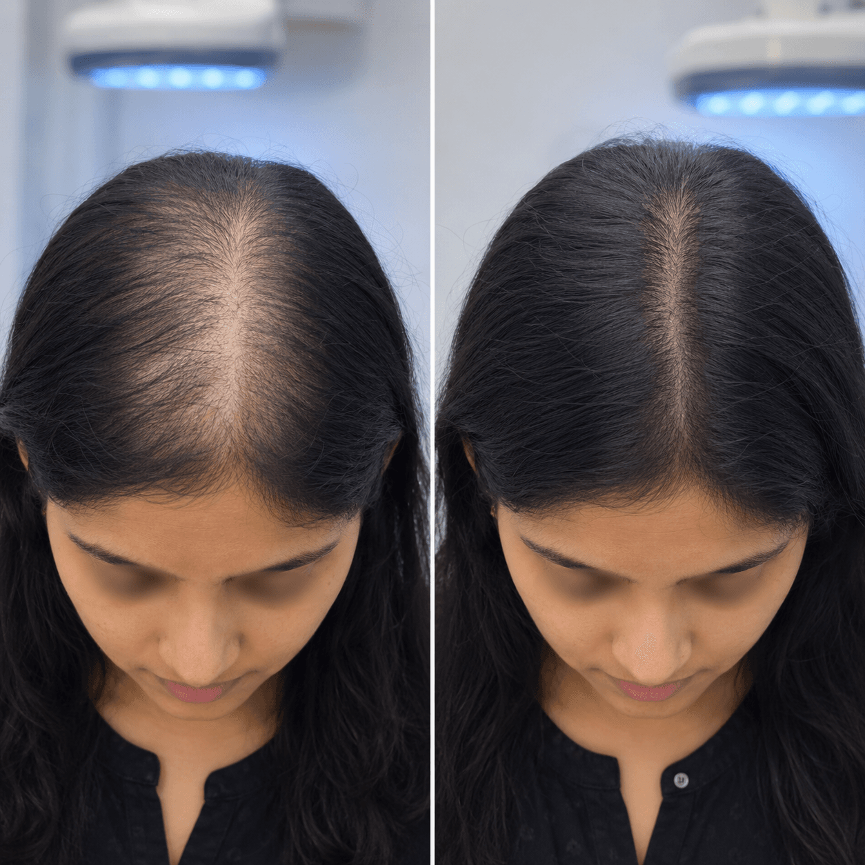 UV light therapy scalp and hair improvement