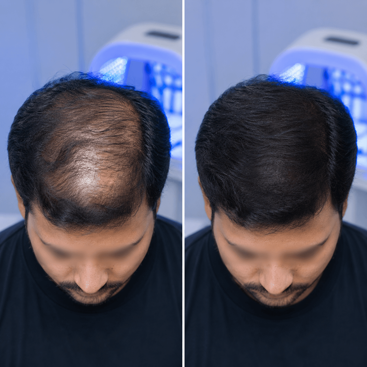 UV light therapy hair outcome visual