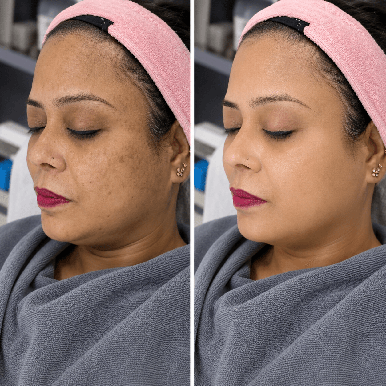 Carbon peel before and after result