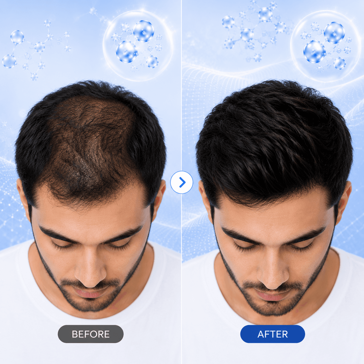 GFC hair density improvement