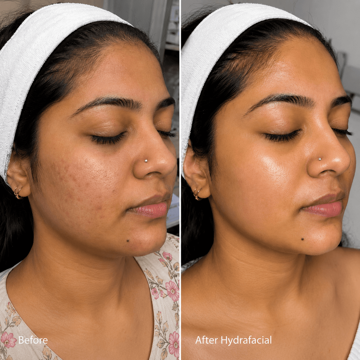 HydraFacial device close-up