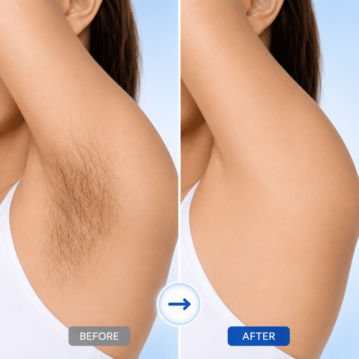 Laser hair removal treatment showcase